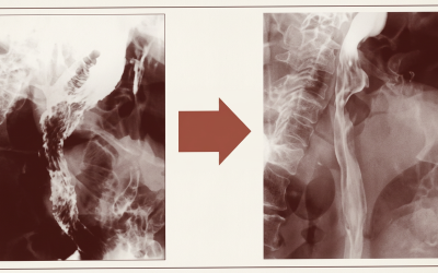 Speiseröhrenkrebs: 10-cm-Tumor verschwunden